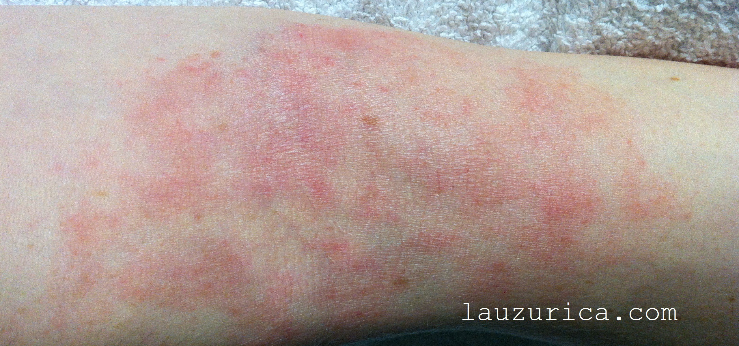 Eczema (Atopic Dermatitis) Quiz: Treatment, Symptoms ...