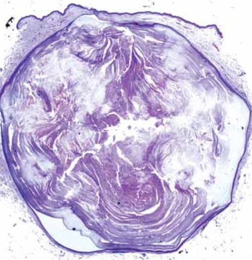 Quiste epidérmico visto al microscopio. Se aprecia fácilmente la cápsula,queratina en su interior y mínimo orificio hacia el exterior. Extraido de publicación J.L.Rodriguez Peralto, J.Cuevas y R. Carrillo