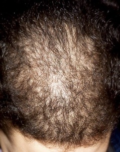 Grado de alopecia avanzado en escala de Ludwig