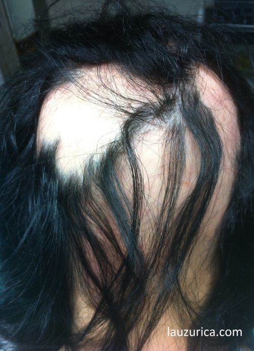 Alopecia areata de larga evolución, con mechones enrocados