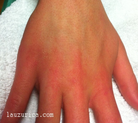 Afectación de dedos, la zona en más contacto, menor en dorso de manos
